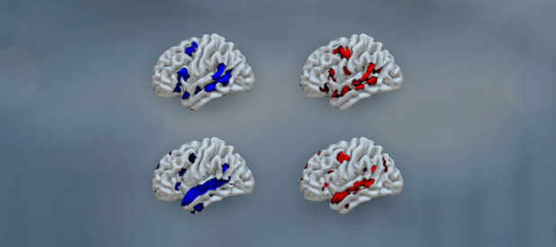 An illustration of four brains seen from the side view with areas highlighted in blue and red.